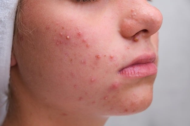 acne teenage girl with pimples h