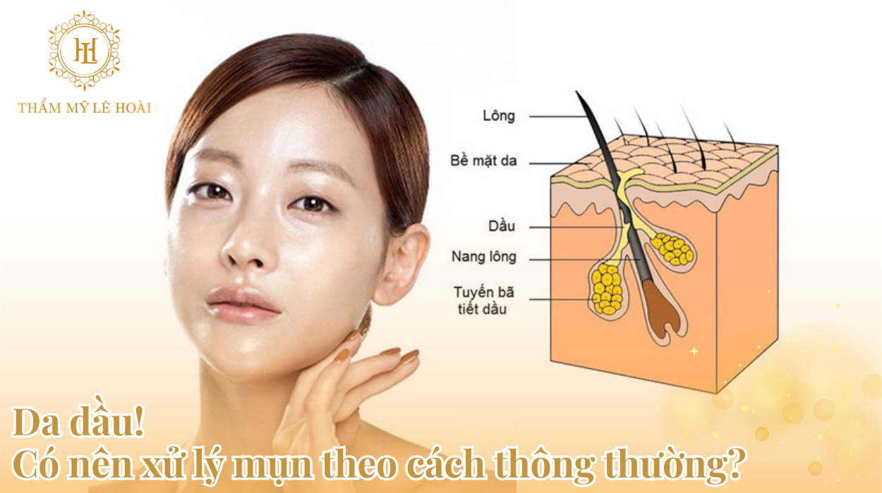 Da dầu có nên xử lý mụn theo cách thông thường