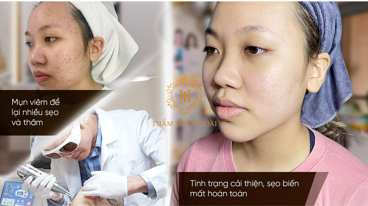 ĐIỀU TRỊ MỤN TẠI TM LÊ HOÀI