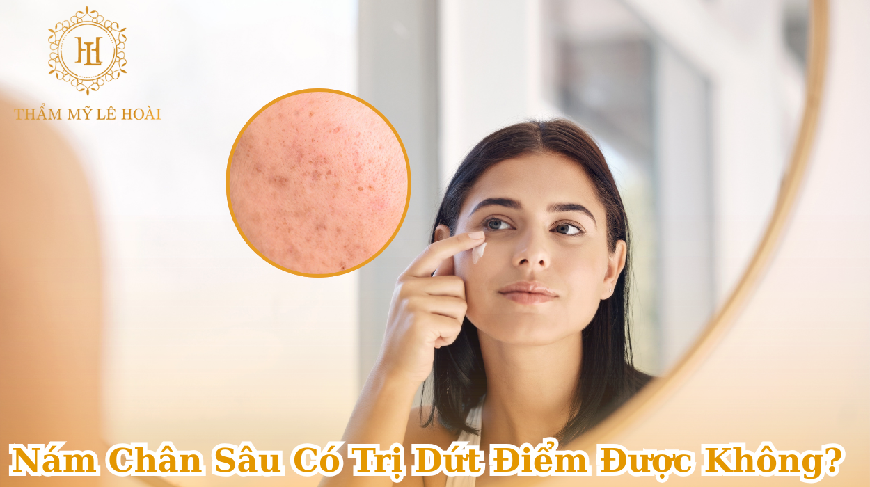 Nám Chân Sâu Có Trị Dứt Điểm Được Không?
