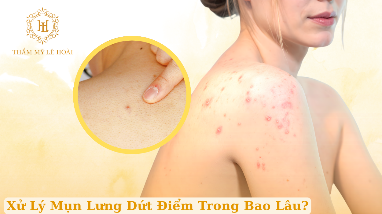 Xử Lý Mụn Lưng Dứt Điểm Trong Bao Lâu? Giải Đáp Chuẩn Nhất Từ Chuyên Gia | Thẩm mỹ Lê Hoài
