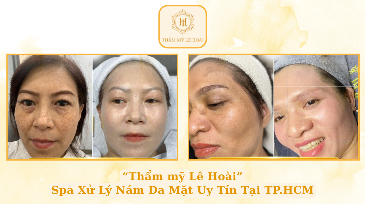 Spa xử lý nám da mặt uy tín Tp. HCM | Thẩm mỹ Lê Hoài