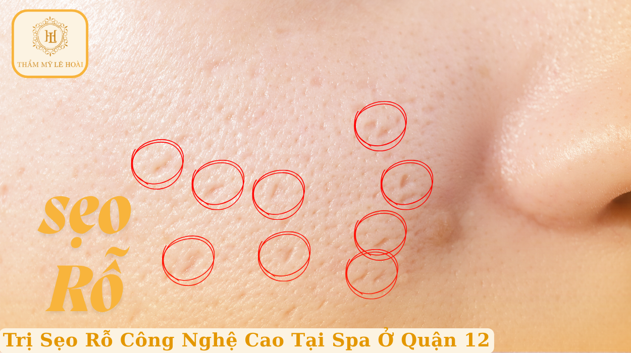 Trị Sẹo Rỗ Công Nghệ Cao Tại Spa Ở Quận 12 | Thẩm mỹ Lê Hoài