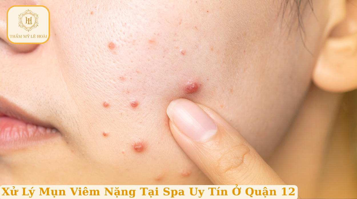 Xử Lý Mụn Viêm Nặng Tại Spa Uy Tín Ở Quận 12 | Thẩm mỹ Lê Hoài