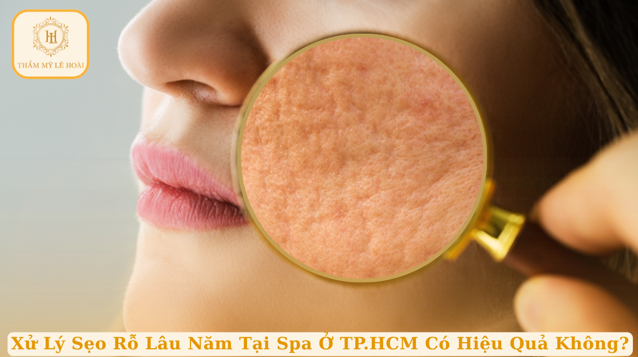 Xử lý sẹo rỗ lâu năm tại Spa ở TP. HCM có hiệu quả không | Thẩm mỹ Lê Hoài